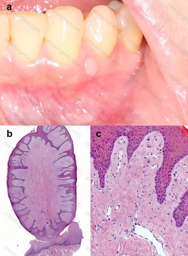 Giant-Cell-Fibroma-of-the-gingiva