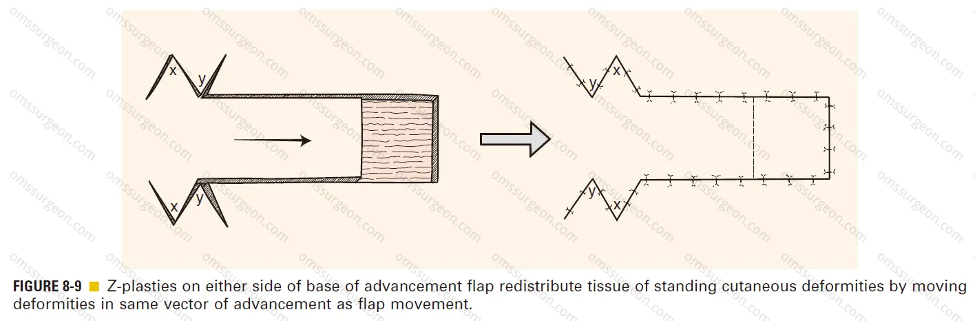 Z-plasties-redistribute-tissue-of-SCD.png