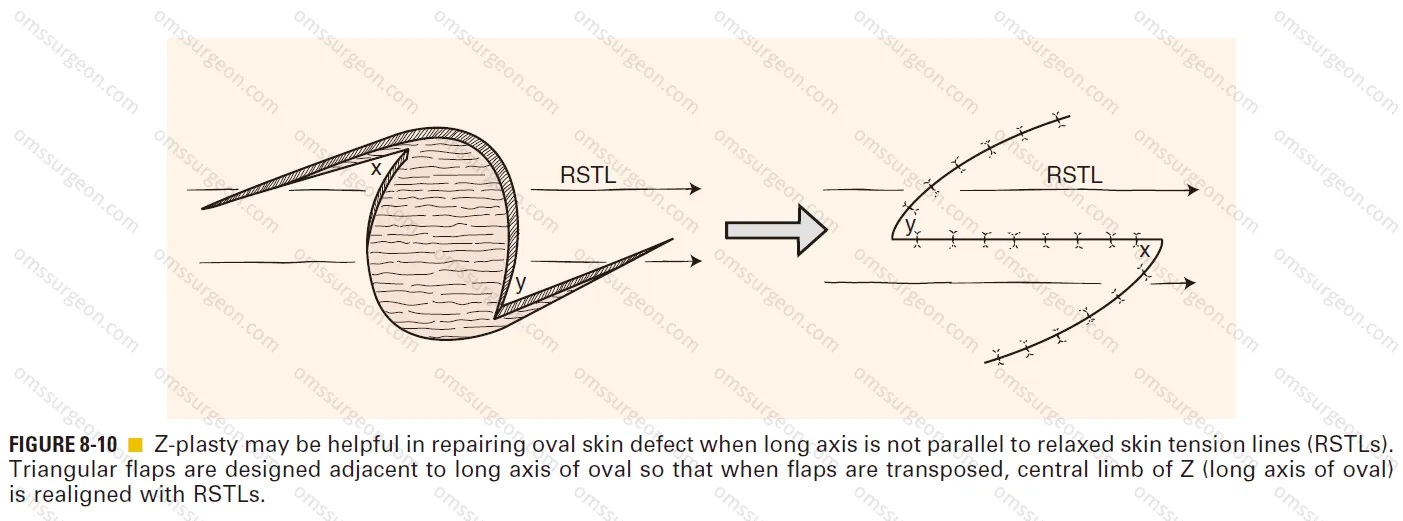 Z-plasties-repair-oval-skin-defect.png