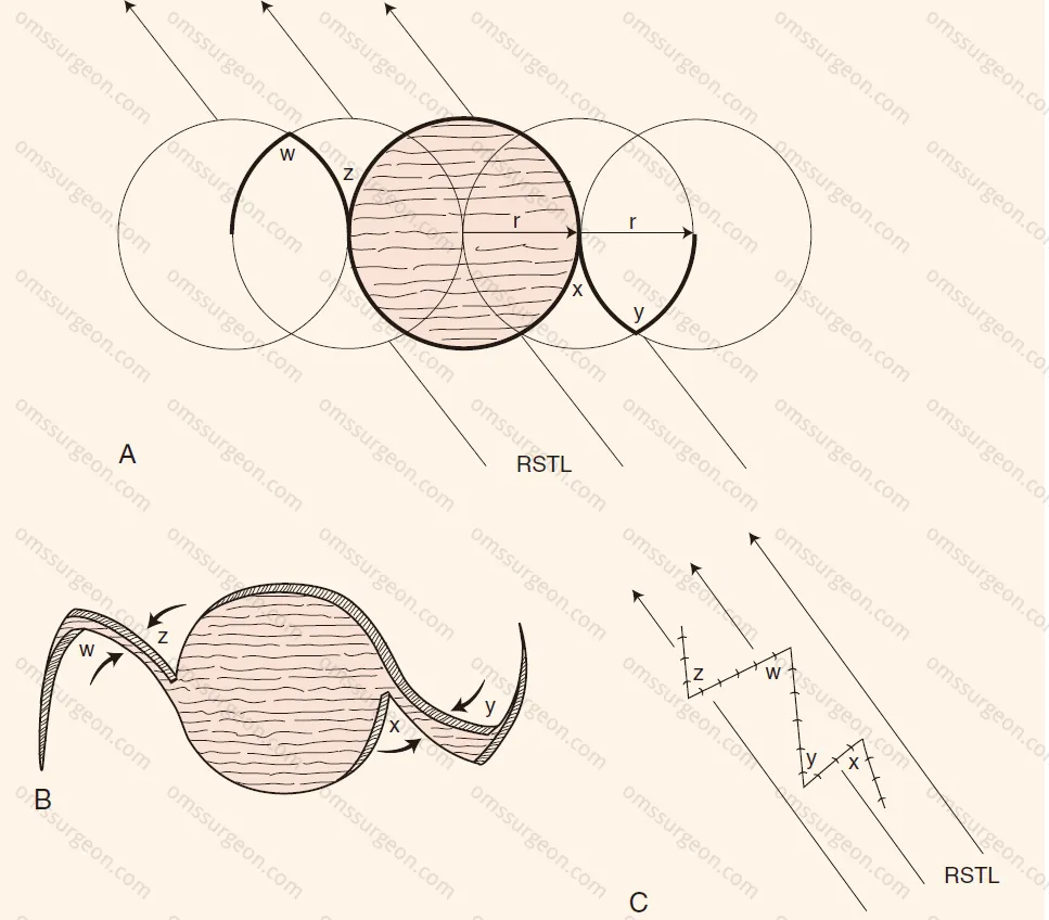 Z-plasties-repairs-circular-skin-defect.png