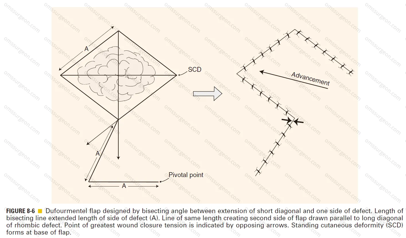 Dufourmentel flap