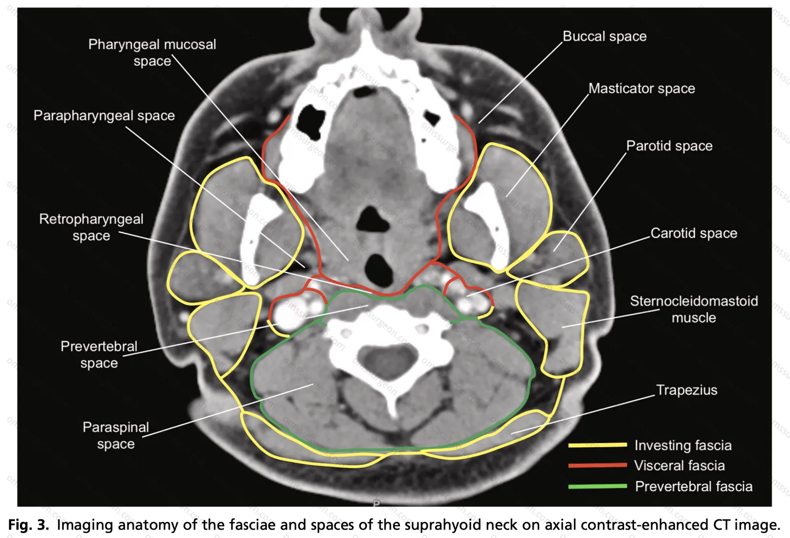 Imaging-of-the-Suprahyoid-Spaces-of-the-Head&Neck