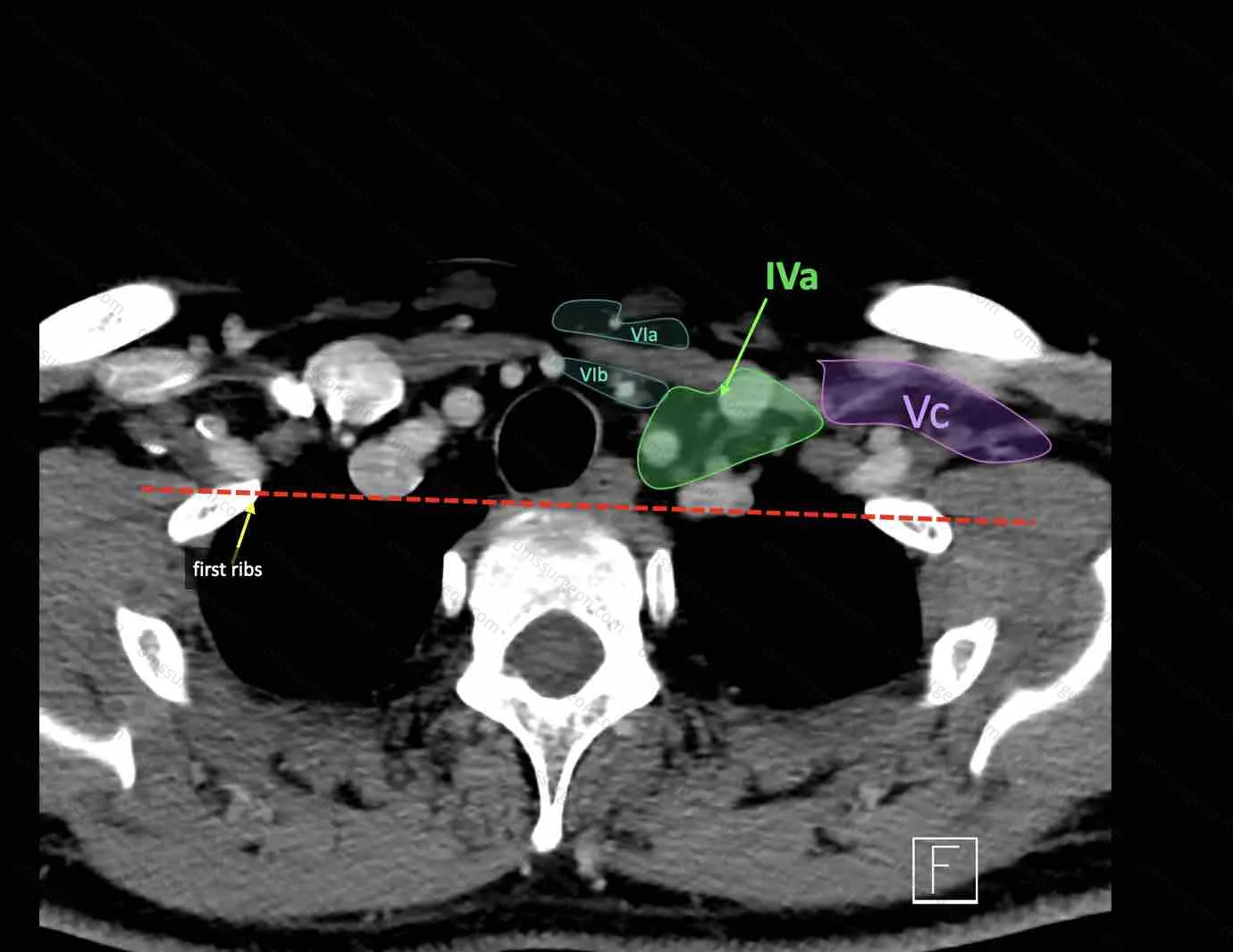 IV2-5