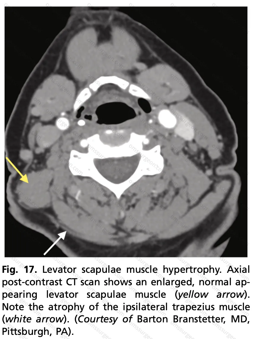 Levator_scapulae_muscle_hypertrophy