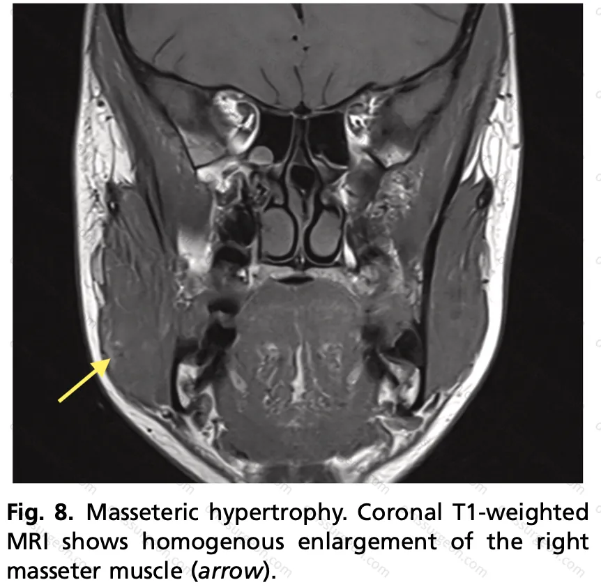 Masseteric_hypertrophy
