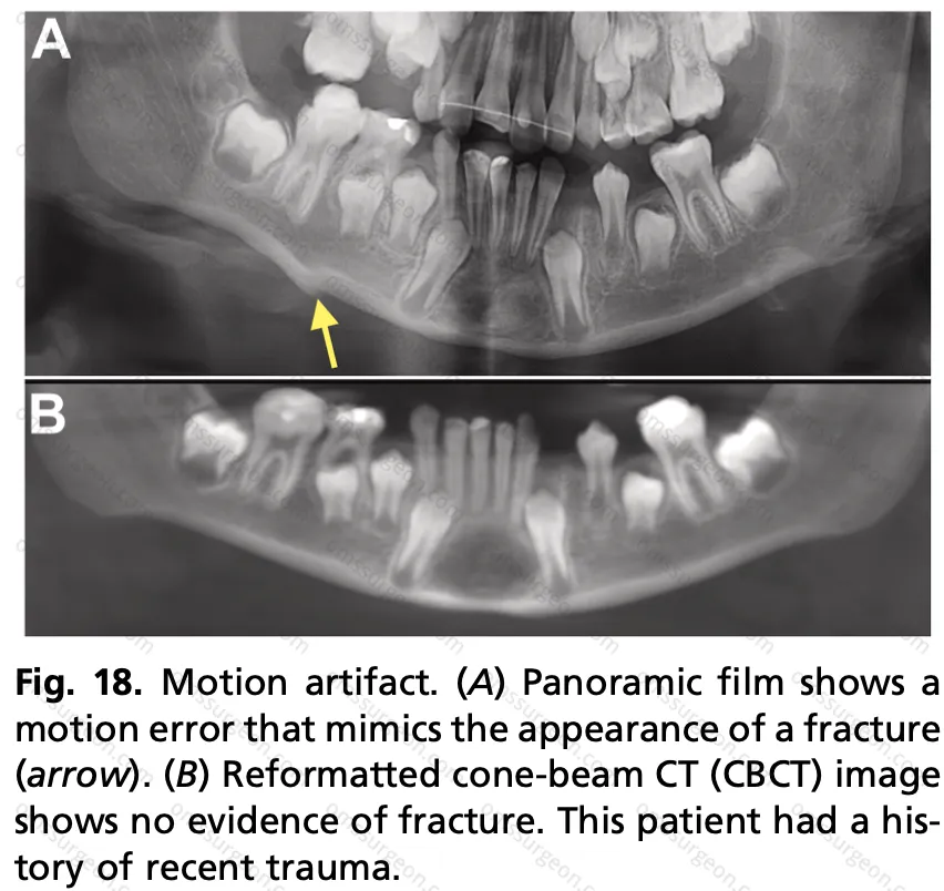 Motion-artifact
