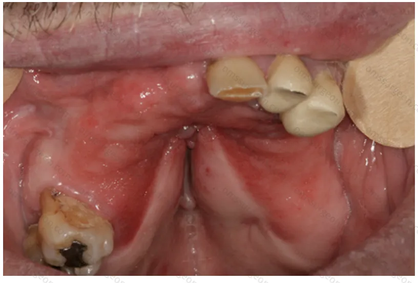 Paget’s disease (monostotic)