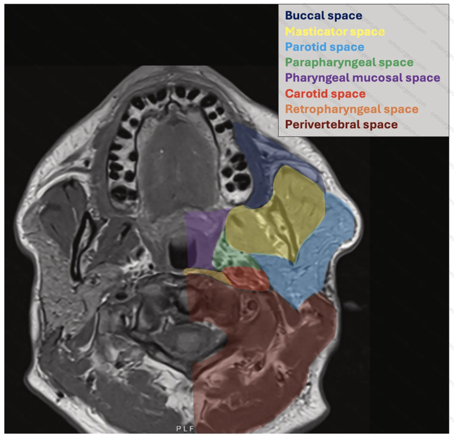 Prapharyngeal&pharyngeal_mucosal-spaces-1