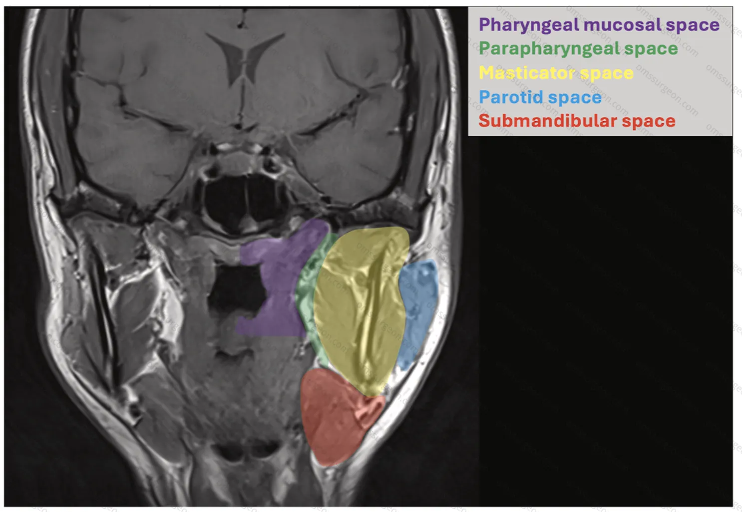 Prapharyngeal&pharyngeal_mucosal-spaces-2