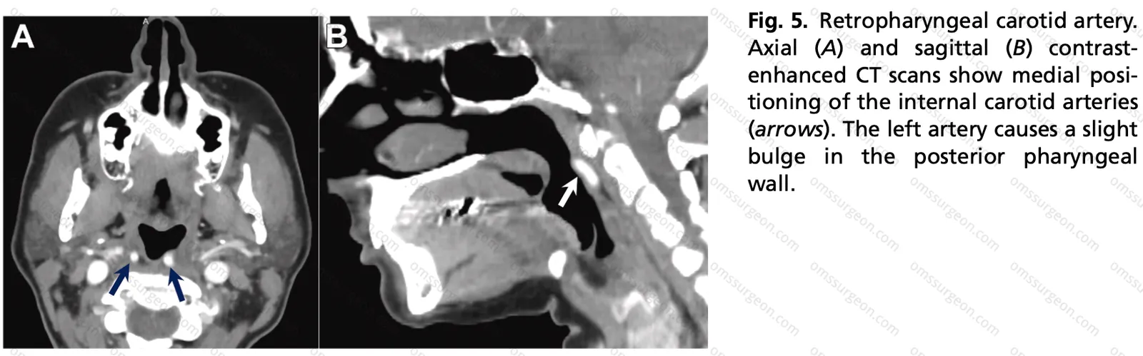 Retropharyngeal_carotid_artery