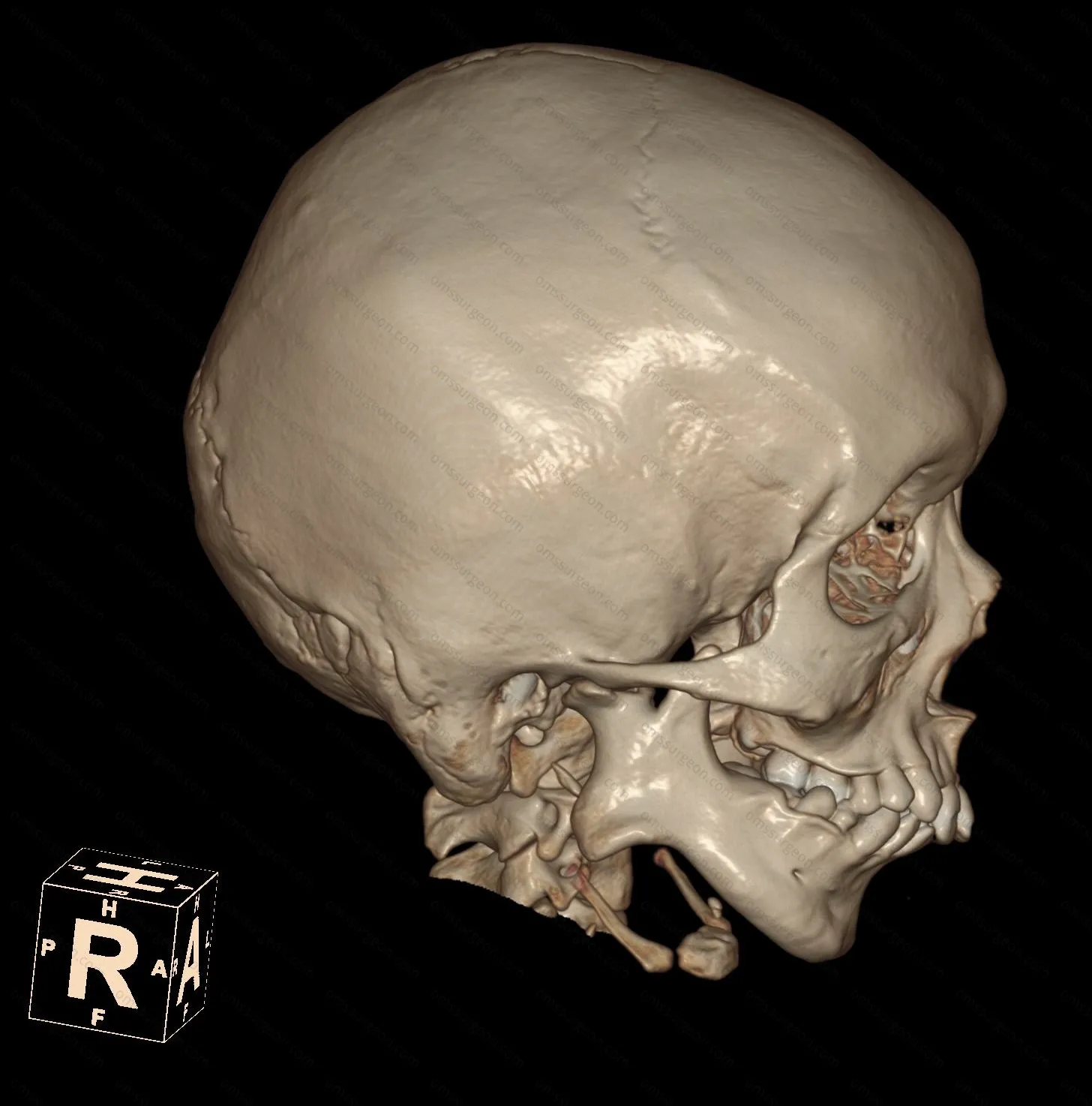 TMJ-Ankylosis