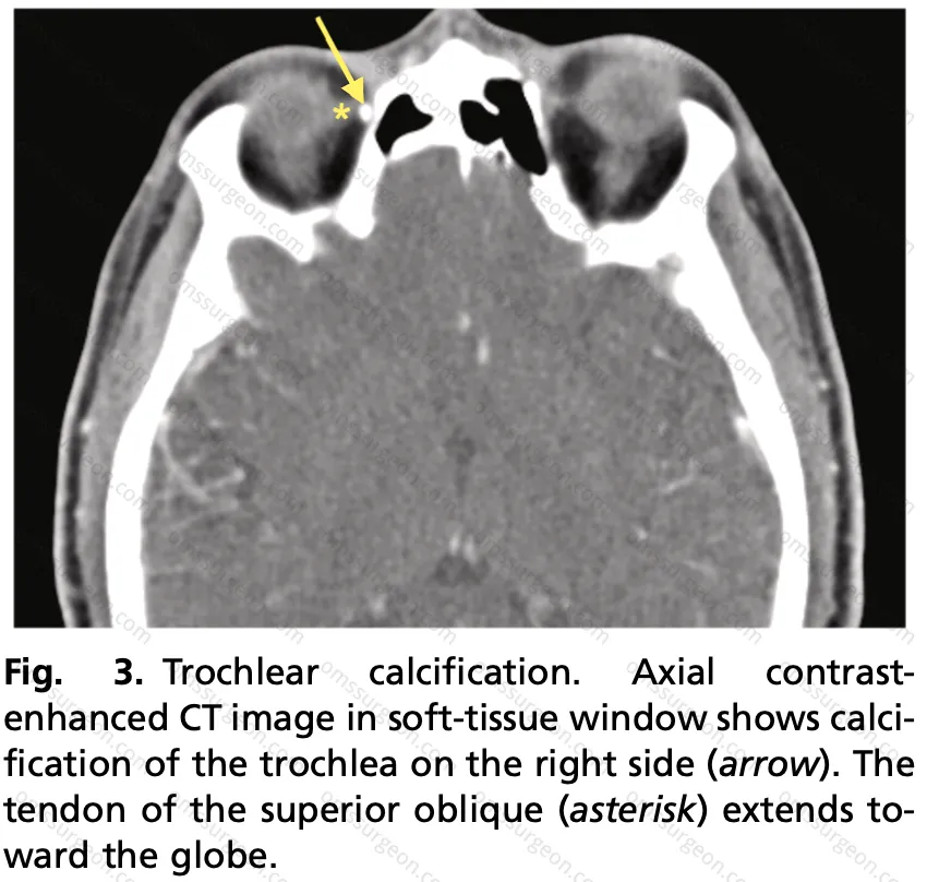 TROCHLEAR_CALCIFICATION