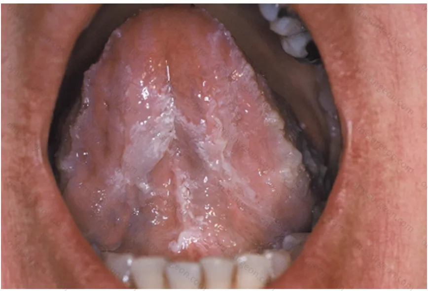 Uremic stomatitis